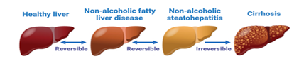 NAFLD stages